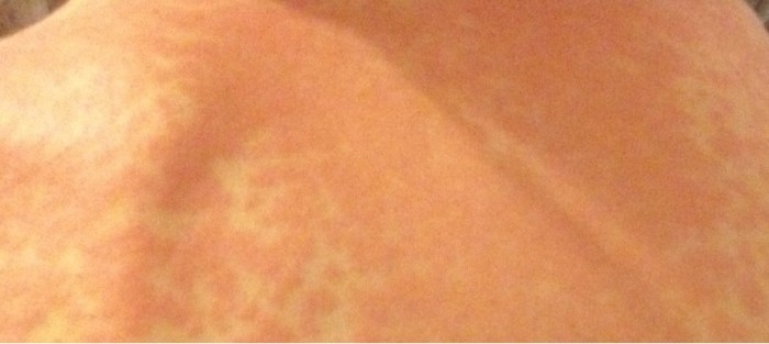 Enfermería dermatológica